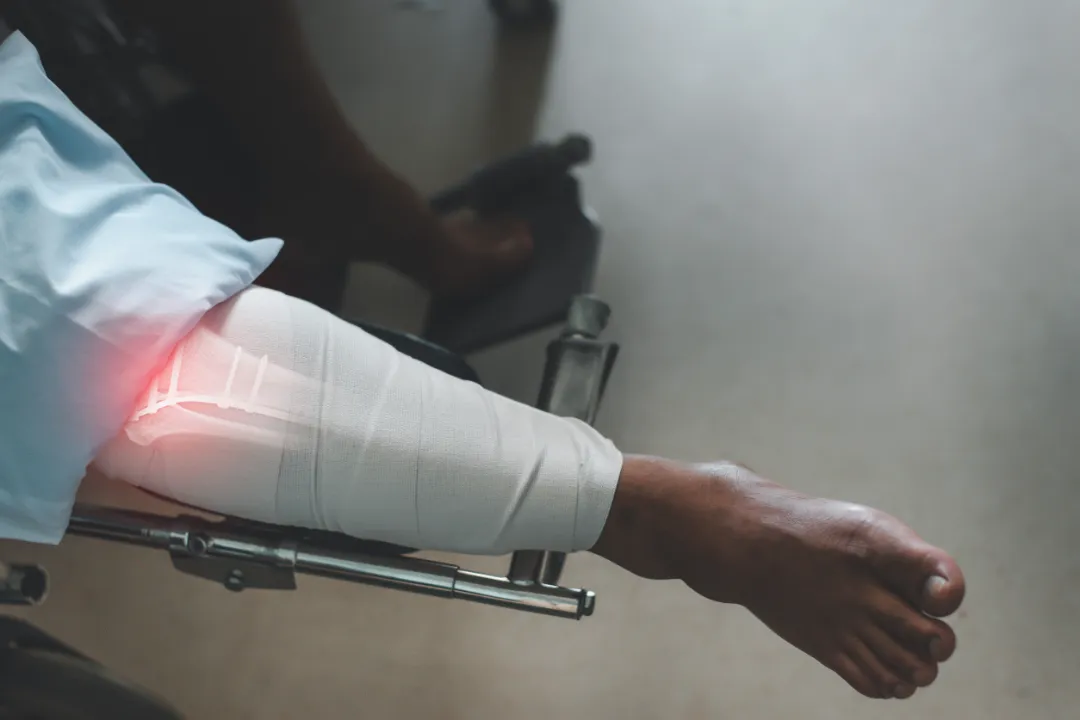 Close up of a boy with plaster arm
